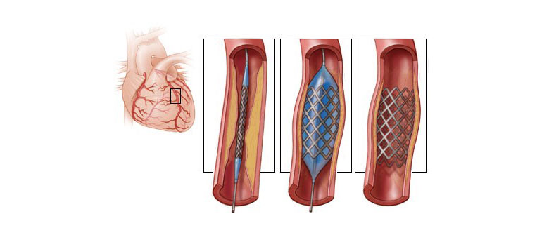 مقایسه دو روش جراحی بایپس عروق کرونری و آنژیوپلاستی Compare two methods Coronary Artery Bypass Surgery and Angioplasty
